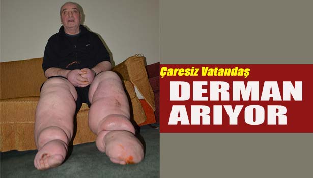 FİL HASTALIĞINA YAKALANAN ÇARESİZ VATANDAŞ, YARDIM BEKLİYOR