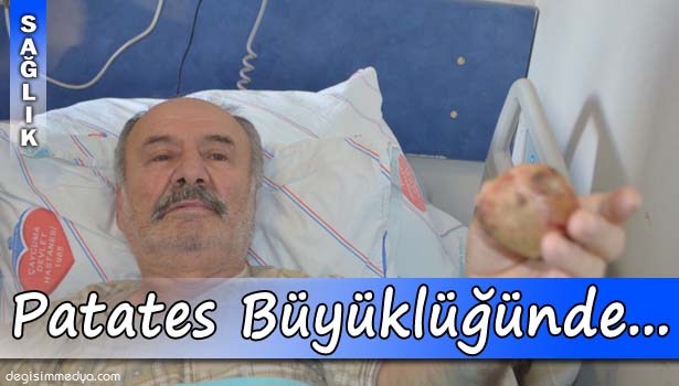 HASTANIN BÖBREĞİNDEN PATATES BÜYÜKLÜĞÜNDE TAŞ ÇIKTI