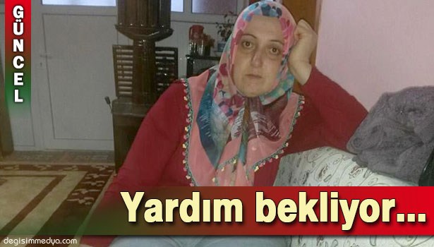 'FİL HASTALIĞI'NA YAKALANAN KADIN AMELİYAT OLABİLMESİ İÇİN YARDIM BEKLİYOR
