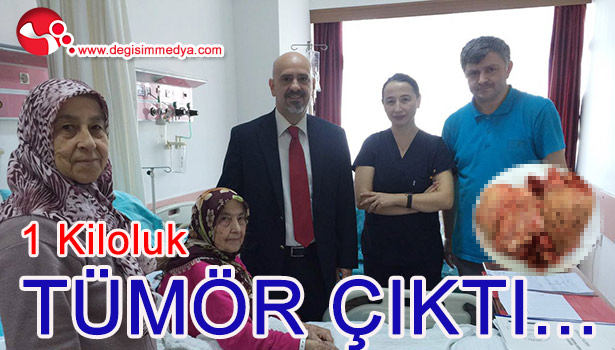 1 KİLOLUK TÜMÖR ÇIKTI...