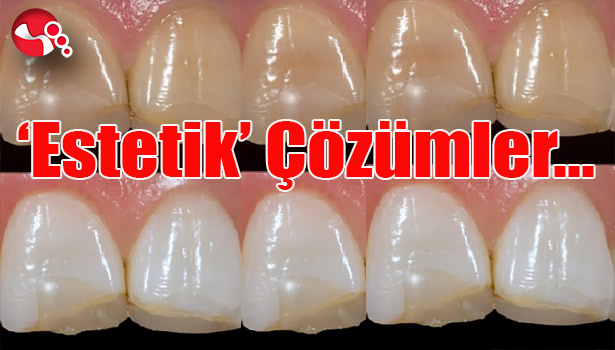 Diş Hekimliği Uygulama ve Araştırma Merkezi'nde 'Estetik' Çözümler...