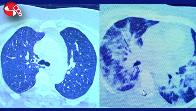 İlaç kullanan korona hastaları ile kullanmayanlar arasındaki inanılmaz fark