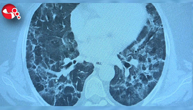 Korona virüs geçiren hastalarda yeni klinik bulgular: 'Uzamış Covid ve post Covid'