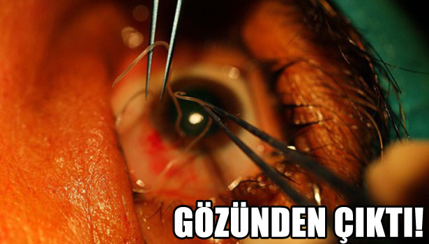 GÖZÜNDEN SOLUCAN ÇIKTI!