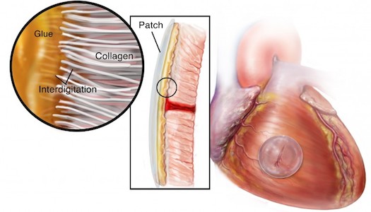 KALP DELİĞİ TEDAVİSİ İÇİN "SÜPERYAPIŞTIRICI" GELİŞTİRİLDİ