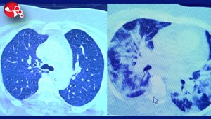 İlaç kullanan korona hastaları ile kullanmayanlar arasındaki inanılmaz fark